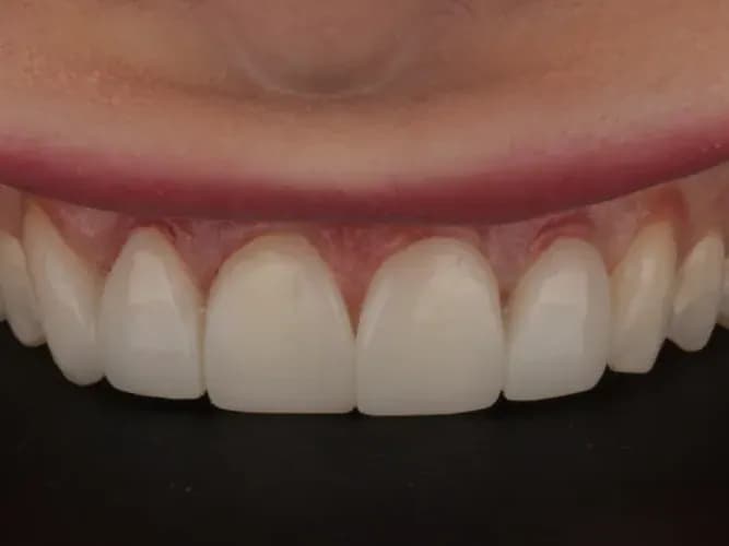 A patient's smile after composite bonding