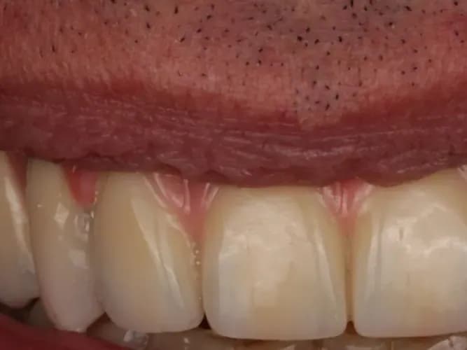 A patient's smile after dental implant treatment