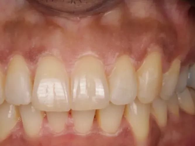 A patient's teeth after Invisalign treatment