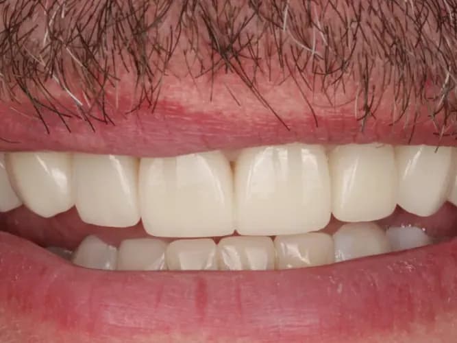 A patient's smile after a porcelain veneer makeover