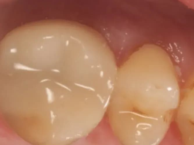 A ceramic crown fitted on a back tooth
