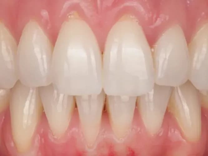 A patient's front teeth after professional whitening